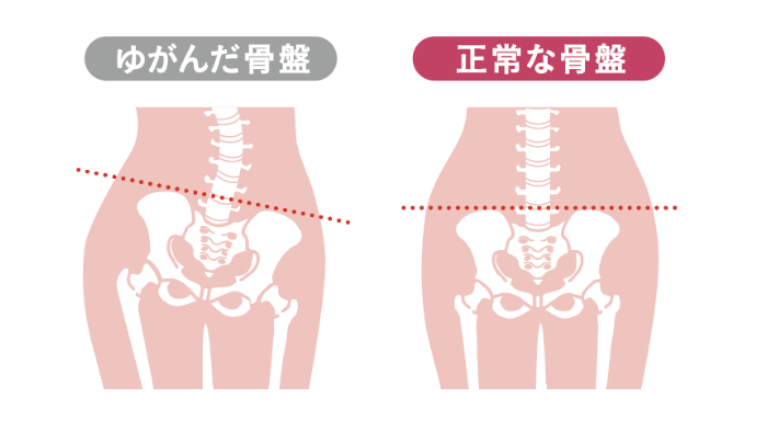 ゆがんだ骨盤と正常な骨盤の比較イラスト